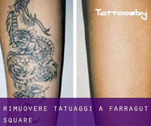 Rimuovere Tatuaggi a Farragut Square