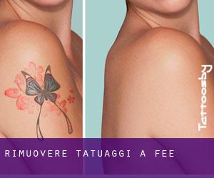 Rimuovere Tatuaggi a Fee