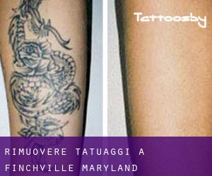 Rimuovere Tatuaggi a Finchville (Maryland)