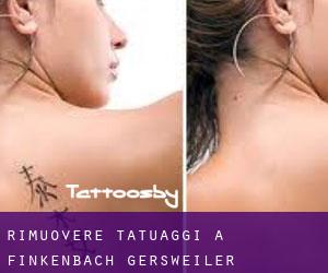 Rimuovere Tatuaggi a Finkenbach-Gersweiler