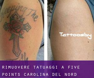 Rimuovere Tatuaggi a Five Points (Carolina del Nord)