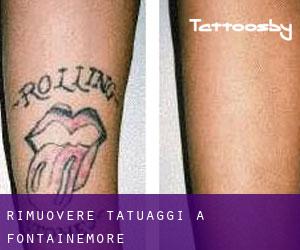 Rimuovere Tatuaggi a Fontainemore