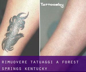 Rimuovere Tatuaggi a Forest Springs (Kentucky)