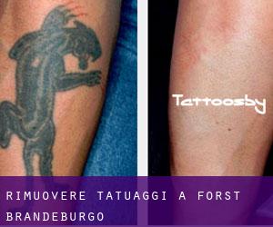 Rimuovere Tatuaggi a Forst (Brandeburgo)