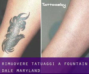 Rimuovere Tatuaggi a Fountain Dale (Maryland)