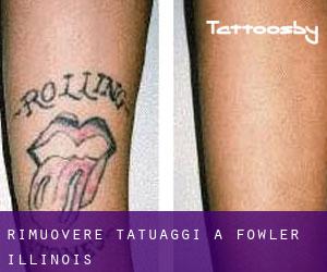 Rimuovere Tatuaggi a Fowler (Illinois)
