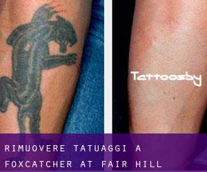 Rimuovere Tatuaggi a Foxcatcher at Fair Hill