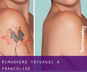 Rimuovere Tatuaggi a Francolise