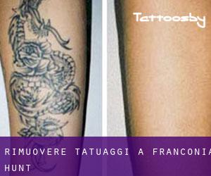 Rimuovere Tatuaggi a Franconia Hunt