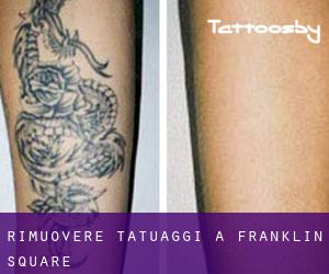 Rimuovere Tatuaggi a Franklin Square
