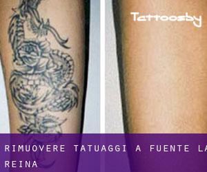 Rimuovere Tatuaggi a Fuente la Reina