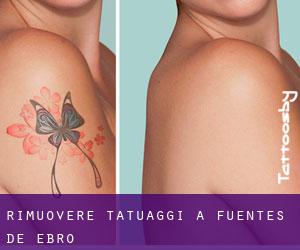 Rimuovere Tatuaggi a Fuentes de Ebro