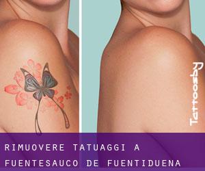 Rimuovere Tatuaggi a Fuentesaúco de Fuentidueña