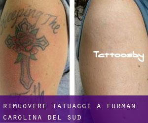 Rimuovere Tatuaggi a Furman (Carolina del Sud)
