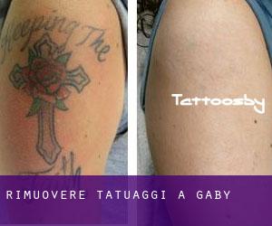 Rimuovere Tatuaggi a Gaby