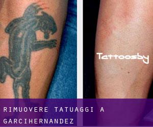 Rimuovere Tatuaggi a Garcihernández