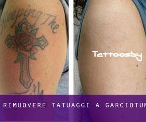 Rimuovere Tatuaggi a Garciotum
