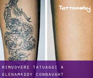 Rimuovere Tatuaggi a Glenamaddy (Connaught)