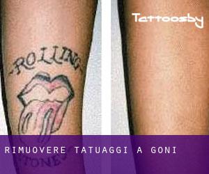 Rimuovere Tatuaggi a Goni