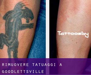 Rimuovere Tatuaggi a Goodlettsville