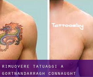 Rimuovere Tatuaggi a Gortnandarragh (Connaught)