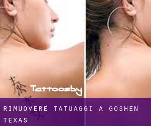 Rimuovere Tatuaggi a Goshen (Texas)