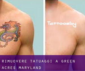Rimuovere Tatuaggi a Green Acres (Maryland)