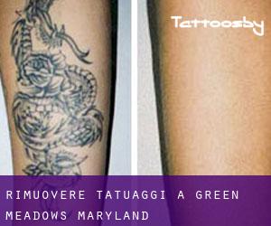 Rimuovere Tatuaggi a Green Meadows (Maryland)