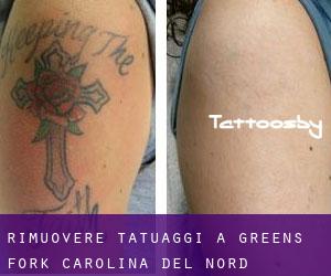 Rimuovere Tatuaggi a Greens Fork (Carolina del Nord)