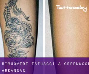 Rimuovere Tatuaggi a Greenwood (Arkansas)