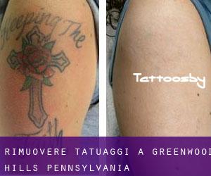 Rimuovere Tatuaggi a Greenwood Hills (Pennsylvania)