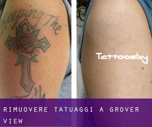 Rimuovere Tatuaggi a Grover View