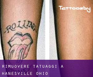 Rimuovere Tatuaggi a Hanesville (Ohio)