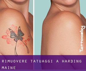 Rimuovere Tatuaggi a Harding (Maine)