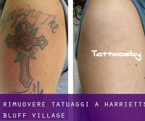 Rimuovere Tatuaggi a Harrietts Bluff Village