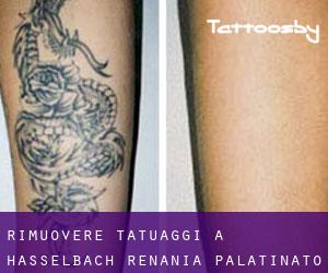 Rimuovere Tatuaggi a Hasselbach (Renania-Palatinato)