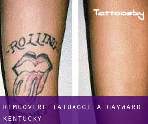Rimuovere Tatuaggi a Hayward (Kentucky)