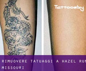 Rimuovere Tatuaggi a Hazel Run (Missouri)
