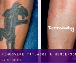 Rimuovere Tatuaggi a Henderson (Kentucky)