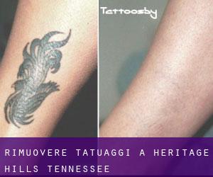 Rimuovere Tatuaggi a Heritage Hills (Tennessee)