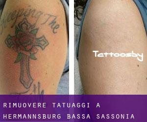 Rimuovere Tatuaggi a Hermannsburg (Bassa Sassonia)