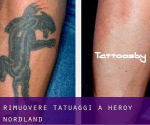 Rimuovere Tatuaggi a Herøy (Nordland)