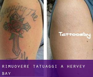 Rimuovere Tatuaggi a Hervey Bay