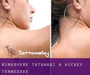 Rimuovere Tatuaggi a Hickey (Tennessee)