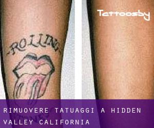 Rimuovere Tatuaggi a Hidden Valley (California)