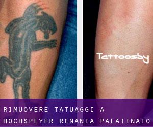 Rimuovere Tatuaggi a Hochspeyer (Renania-Palatinato)
