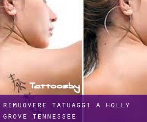 Rimuovere Tatuaggi a Holly Grove (Tennessee)