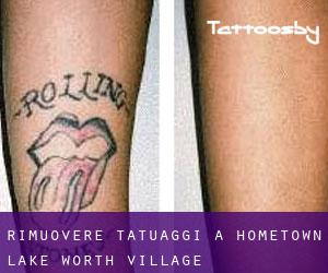 Rimuovere Tatuaggi a Hometown Lake Worth Village