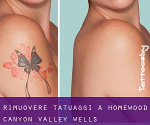 Rimuovere Tatuaggi a Homewood Canyon-Valley Wells