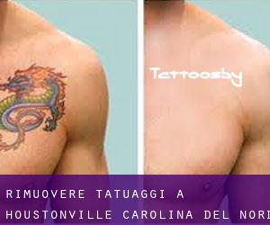 Rimuovere Tatuaggi a Houstonville (Carolina del Nord)
